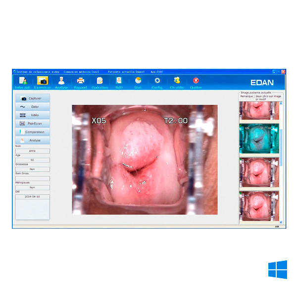 colposcope vidéo edan c6a